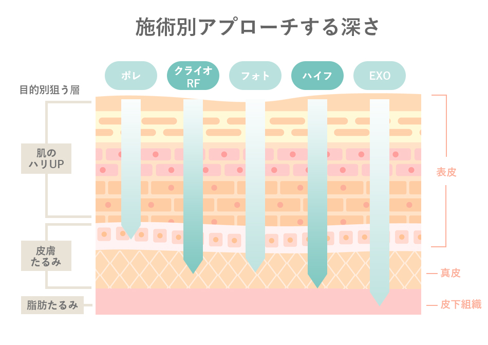 ラジオ波