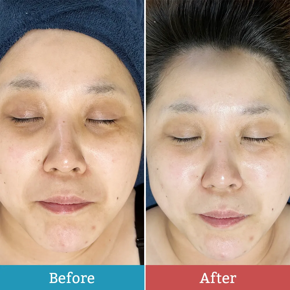 ララピールのBefore-After