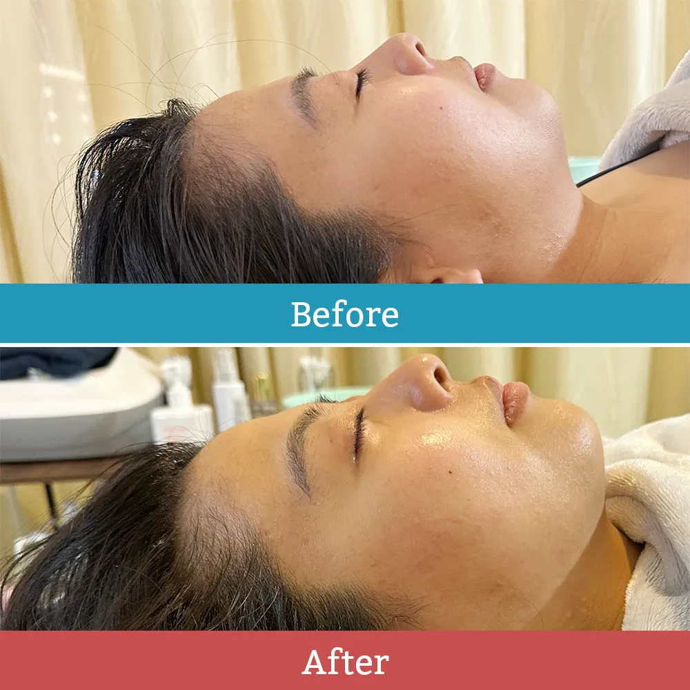 ラジオ波のBefore-After